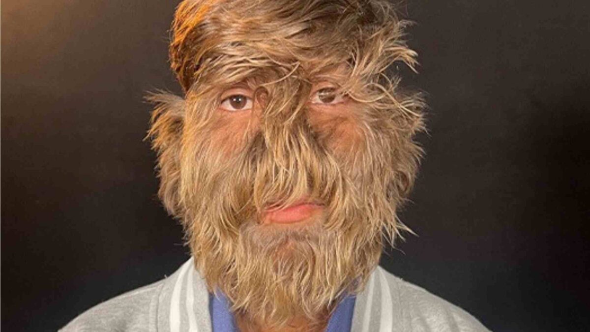 Hombre con la cara mas peluda del mundo Guinness World Records  scaled
