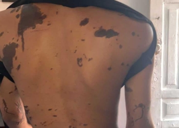Madre e hija de 15 años sufren ataque con “ácido del diablo” en capotillo