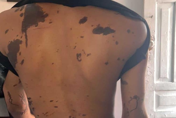 Madre e hija de 15 años sufren ataque con “ácido del diablo” en capotillo
