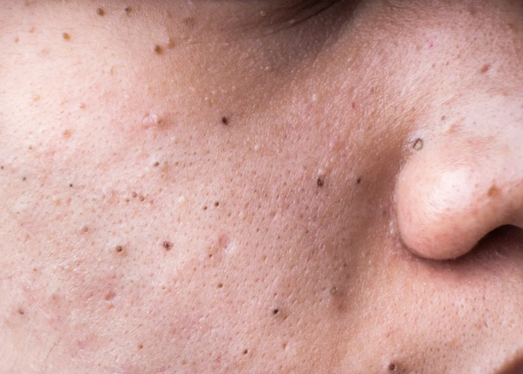 Guía completa para eliminar puntos negros y mantener una piel saludable