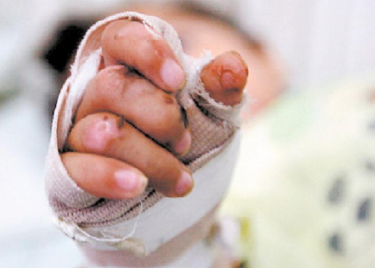 Niños de 4 años y 4 meses sufren quemaduras por incendio en hato mayor