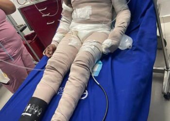 Hombre sufre quemaduras de segundo grado, luego de que su pareja le lanzara agua caliente