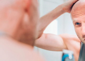 Clascoterone tópico muestra alta eficacia en alopecia masculina