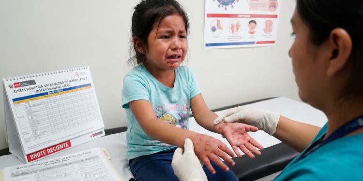 Reportan 144 casos de virus coxsackie en colegios de lima metropolitana